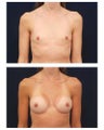 Breast Augmentation