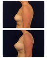 Breast Augmentation