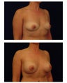 Breast Augmentation