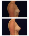 Breast Augmentation