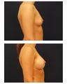 Breast Augmentation