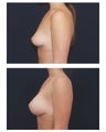Breast Augmentation