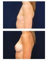 Breast Augmentation