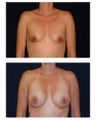 Breast Augmentation