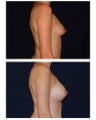 Breast Augmentation