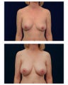 Breast Augmentation