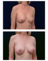 Breast Augmentation
