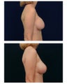 Breast Augmentation