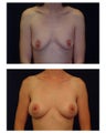 Breast Augmentation