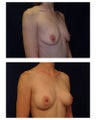 Breast Augmentation