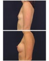 Breast Augmentation
