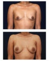 Breast Augmentation