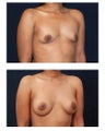 Breast Augmentation