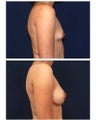 Breast Augmentation