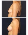 Breast Augmentation