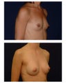 Breast Augmentation