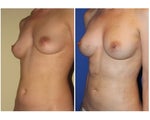Natural Breast Augmentation