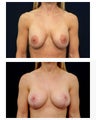 Breast Augmentation