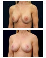 Breast Augmentation