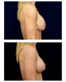 Breast Augmentation