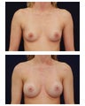 Breast Augmentation