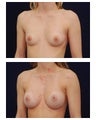 Breast Augmentation