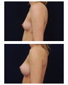 Breast Augmentation