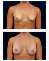 Breast Augmentation