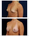Breast Augmentation