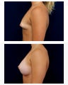 Breast Augmentation