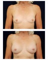 Breast Augmentation