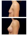 Breast Augmentation