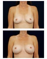 Breast Augmentation
