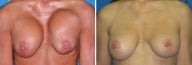 Capsular Contracture, correction with "Capsule Switch" procedure