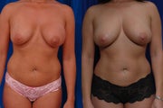 Implant removal and fat grafting