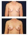 Silicone Gel Breast Augmentation