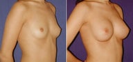 Breast Augmentation