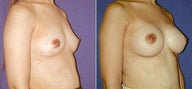 Breast Augmentation
