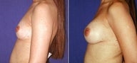 Breast Augmentation