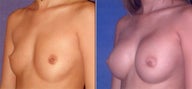 Breast Augmentation