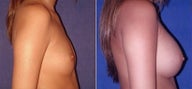 Breast Augmentation