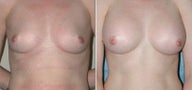 Breast Augmentation