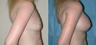 Breast Augmentation