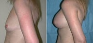 Breast Augmentation
