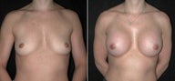 Breast Augmentation
