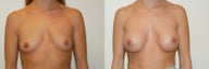 Breast augmentation with silicone breast implants