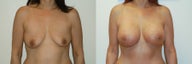 Breast augmentation with silicone breast implants