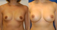 Breast augmentation with silicone breast implants