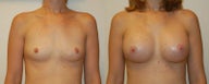 Breast augmentation with silicone breast implants