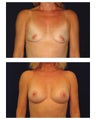 Breast Augmentation